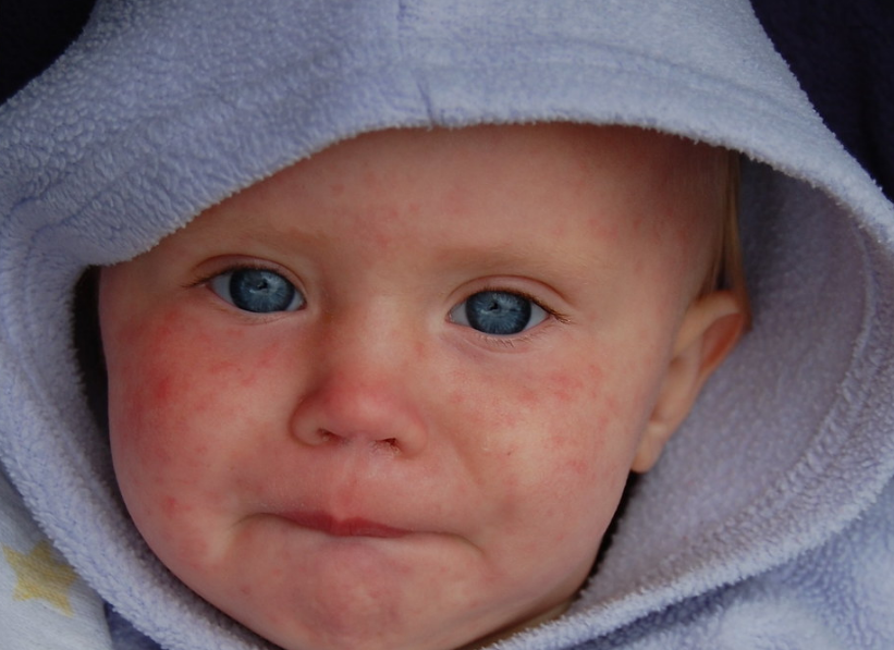 US Measles Outbreak - Case Numbers Broke All Records