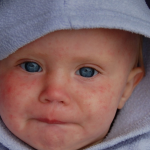 US Measles Cases Increased & Spread To 26 States